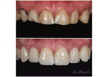 Dr Anthony Hua - BURLEIGH DENTAL STUDIO